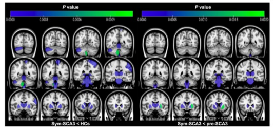 European Radiology：<font color="red">脊髓</font><font color="red">小脑</font><font color="red">共济失调</font>3型的MR脑组织结构改变