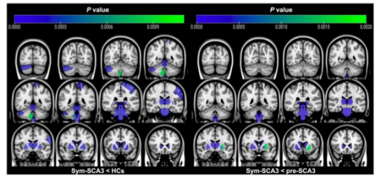 European Radiology：脊髓小脑共济失调3型的MR脑组织<font color="red">结构</font><font color="red">改变</font>