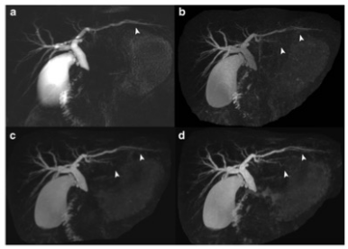 European Radiology：深度学习技术在快速3D屏气MR胰胆管成像中的应用