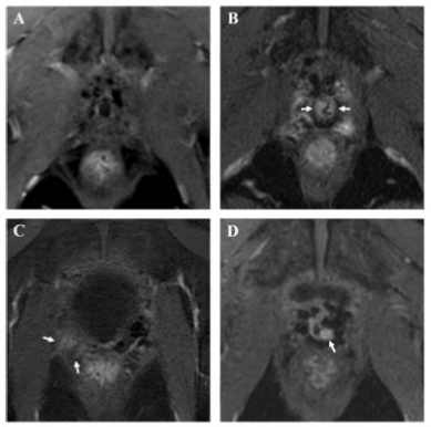 European Radiology：可实现前列腺切除术后复发无创预测的DCE MRI手段！