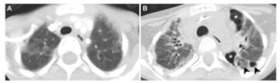 European Radiology：儿童造血干细胞移植后胸膜肺实质纤维弹性变的影像学评估