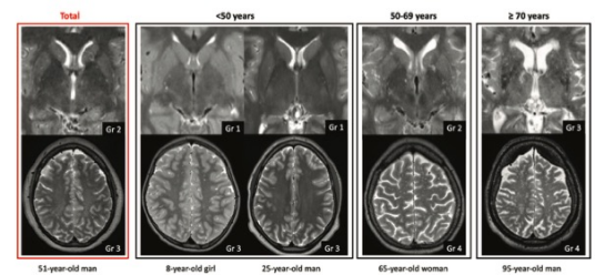 Radiology：MR可见的随年龄变化的大脑血管周围间隙扩张