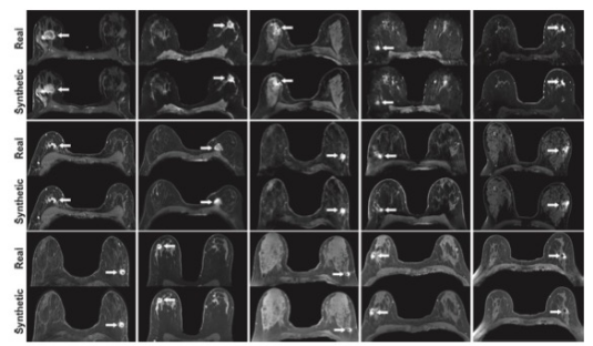 Radiology：深度学习的浸润性乳腺癌模拟增强乳腺MRI