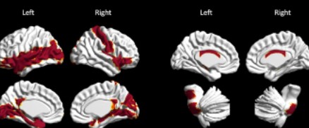 TP：多模态磁共振成像和脑年龄预测精神分裂症患者不同脑区的脑老化轨迹