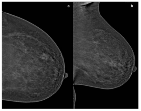 European Radiology：乳腺背景增强在增强光谱乳腺钼靶(CESM)中有何重要临床意义？