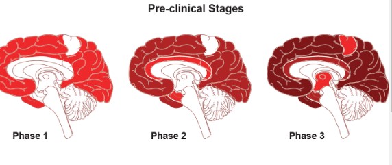 Alzheimer&Dementia：血脑屏障的<font color="red">完整性</font>影响了血浆Aβ蛋白的标志物作用