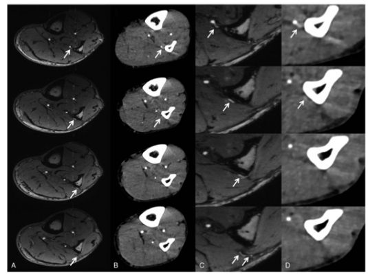 Investigative Radiology：7T TOF MRA在评估腓肠肌穿支动脉中的应用