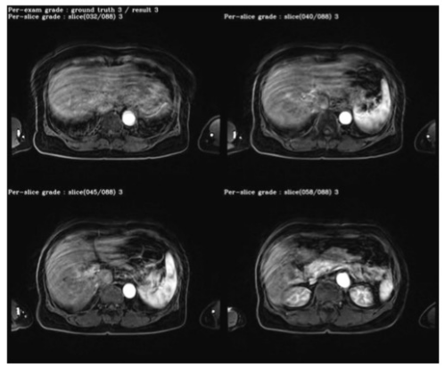 Investigative Radiology；基于深度学习的钆塞酸二钠增强肝脏MRI运动伪影的自动检测与分级