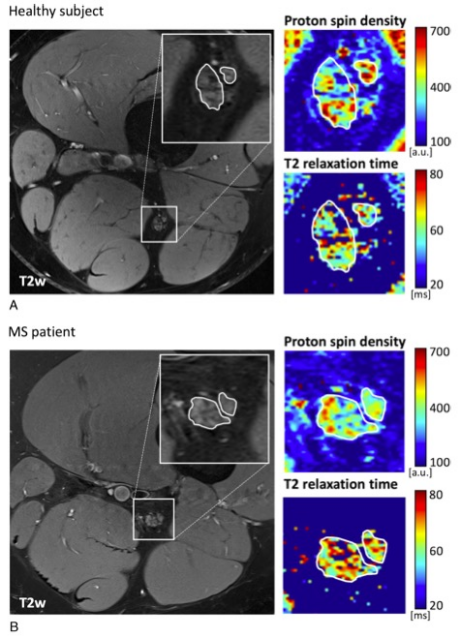 Investigative Radiology：多发性硬化症初诊时周围神经受累发生率的MR神经造影研究