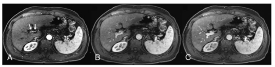 Investigative Radiology：钆塞酸二钠MRI动脉期相<font color="red">采集</font>对肝细胞癌检测的价值