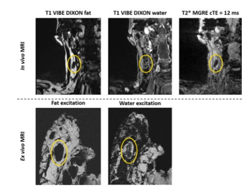 Investigative Radiology：USPIO增强MRI实现头<font color="red">颈部</font><font color="red">淋巴结转移</font>的无创分期