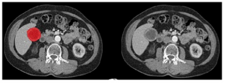 European Radiology：结合视觉评估和CT放射组学的最佳胆囊病变评估