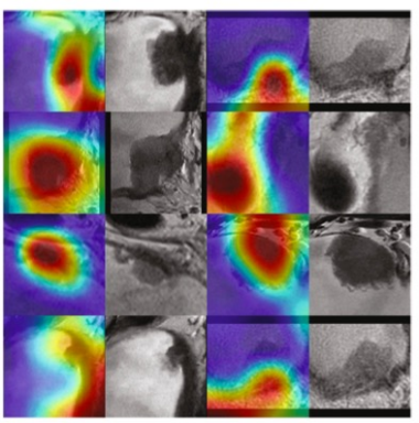 <font color="red">European</font> Radiology：MRI深度学习分析在预测膀胱癌肌肉侵袭方面的价值