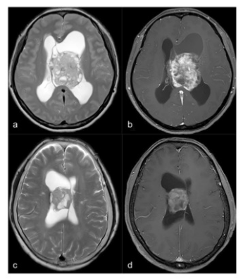 European Radiology：中枢神经细胞瘤和侧脑室胶质瘤的放射组学模型无创分析