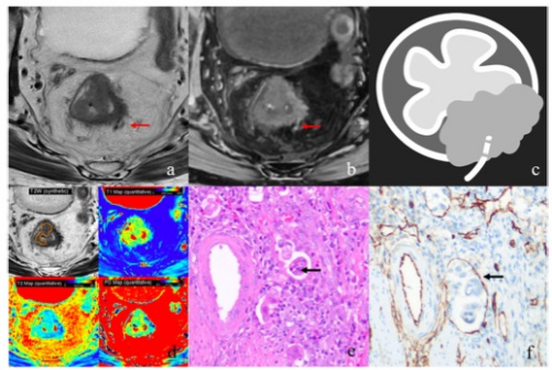 European Radiology：评估直肠癌壁<font color="red">外</font>静脉侵犯的MR新技术！