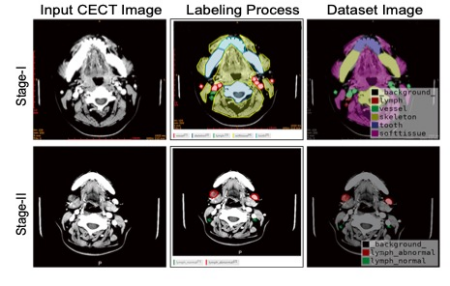 European Radiology：深度学习在口腔癌颈部<font color="red">淋巴结转移</font>诊断方面的应用