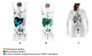European Radiology：卷积神经网络在弥漫性大B细胞淋巴瘤基线<font color="red">PET-CT</font>中的应用