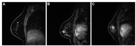 Radiology：乳腺癌MRI动态增强分类对分子亚型的影响