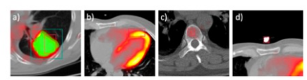 European Radiology：<font color="red">人工</font>智能实现PET/CT的肺癌全自动评估！