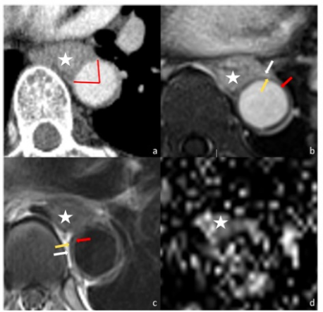 European Radiology：食管癌<font color="red">主动脉</font>及气管支气管浸润的MRI评估