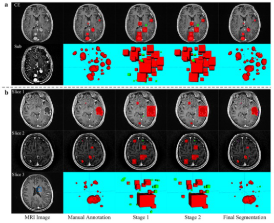European Radiology：基于MRI深度学习的脑转移自动检测与分割