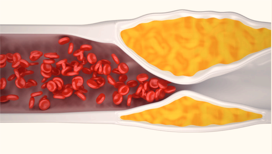 J Ethnopharmacol：三味<font color="red">檀香</font>胶囊通过增加脂肪组织巨噬细胞溶酶体活性减轻动脉粥样硬化