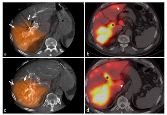 European Radiology：锥形束CT在肝细胞癌TACE中的应用