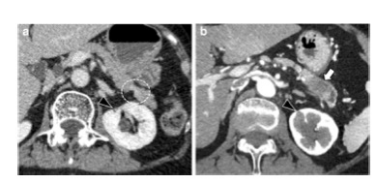 European Radiology：这一影像学表现是诊断早期<font color="red">胰腺癌</font>重要的影像表现