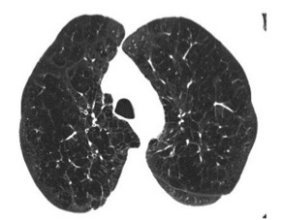 J AM COLL RADIOL：肺癌CT检查偶然发现的快速参考指南