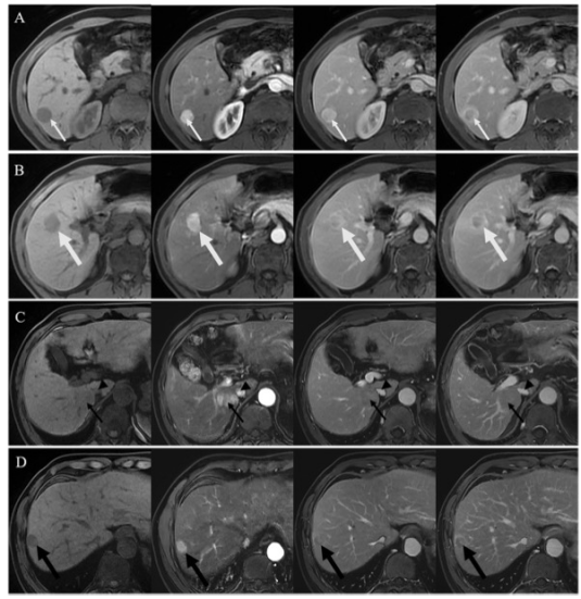 European Radiology:双灶性肝细胞癌术后预测远期预后的影像学因素
