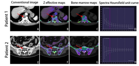European Radiology：双能CT在鉴别<font color="red">脊柱</font>多发性骨髓瘤与椎体溶骨性骨转移方面的价值