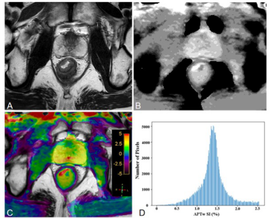 European Radiology:APTw直方图分析预测直肠腺癌管壁外静脉浸润的初步研究