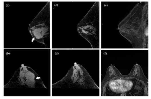 academic radiology:术前锥形束乳腺CT在新辅助化疗后肿瘤残留评估中的价值