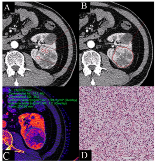 academic radiology:双层光谱CT对透明细胞肾细胞<font color="red">癌病理</font>分级的无创预测