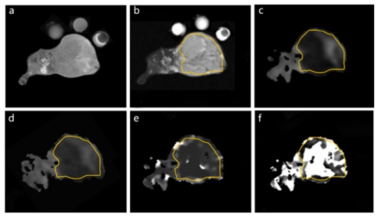 academic radiology：DWI和IVIM全瘤直方图分析在纤维肉瘤风险分层中的应用
