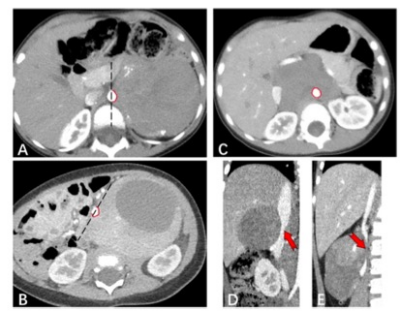 academic radiology：腹部/盆腔神经母细胞瘤的CT表现与术中血管损伤的相关性