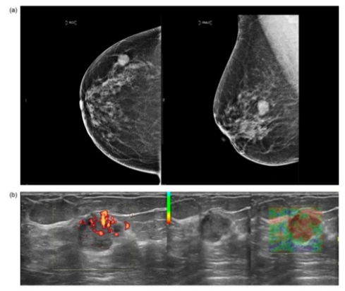 academic radiology:乳腺腺样囊性癌的多模态影像学表现