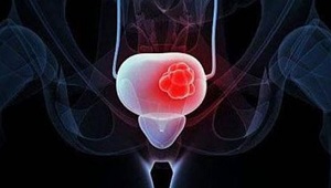 Lancet Oncol：肌肉浸润性膀胱癌的三联疗法