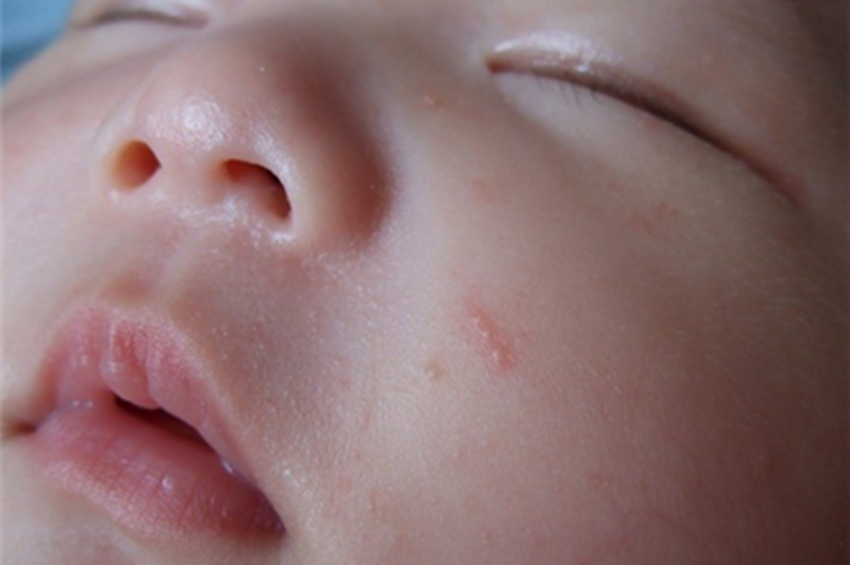 光动力疗法在儿童皮肤病中的应用