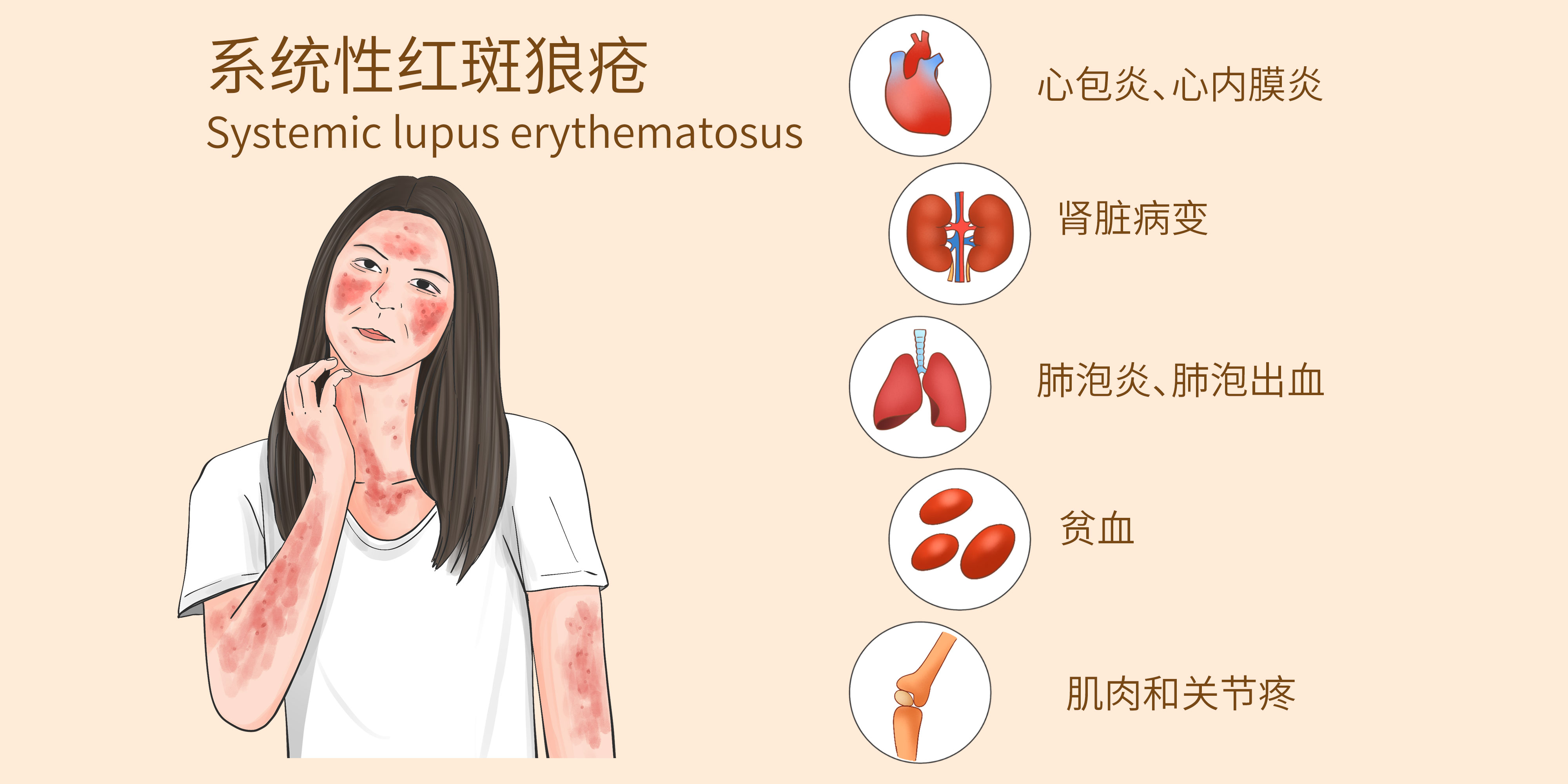 补体低一定就是狼疮复发？这些信号必须读懂！