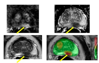 academic radiology：CAD在MRI前列腺癌检测中的应用