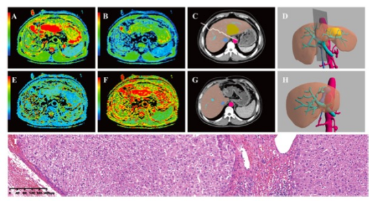 European Radiology：<font color="red">HCC</font>肝切除术后肝再生的术前IVIM评估