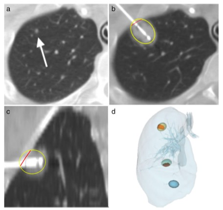 European Radiology：肺部肿瘤经皮冷冻消融和微波消融后发生持续气漏的风险