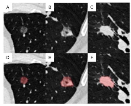 European Radiology：可预测侵袭性非黏液性肺腺癌分化等级的<font color="red">LDCT</font>放射组学模型