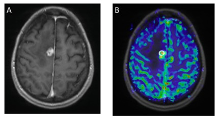 academic radiology：如何实现乳腺癌脑转移患者的无创HER2<font color="red">状态</font>预测？