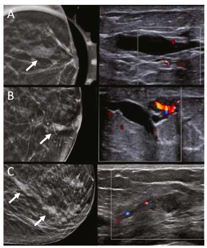 academic radiology：单独导管扩张对乳腺癌诊断的价值及意义
