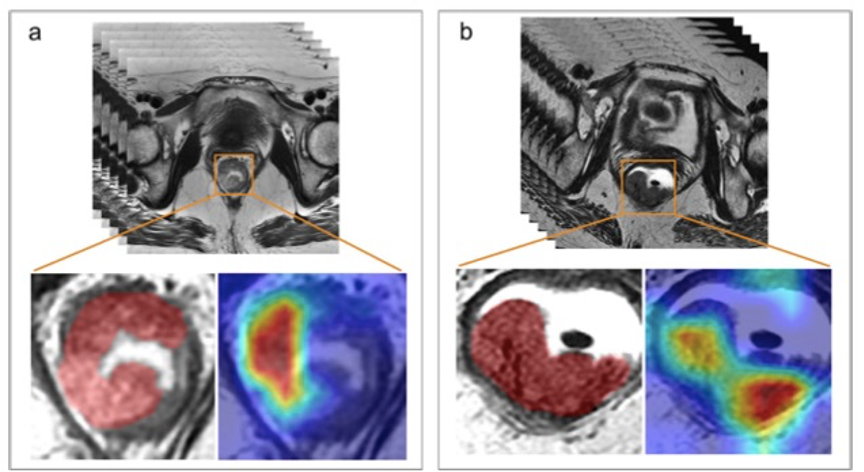 European Radiology：MRI深度学习在预测T<font color="red">1</font>-<font color="red">2</font>期直肠癌淋巴结转移方面的价值