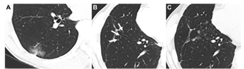 Radiology：肺腺癌切除后的复发类型和患者预后会因CT上是否有GGO不同而不同！