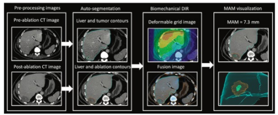 Radiology：CT图像配准与自动分割在结直肠癌肝转移瘤热<font color="red">消融</font>中的应用