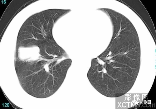 【<font color="red">病例</font>】右肺下叶小细胞癌CT<font color="red">病例</font>图片影像诊断分析！